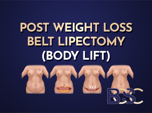 Post Weight Loss Belt Lipectomy (Body Lift) After Significant Weight Loss