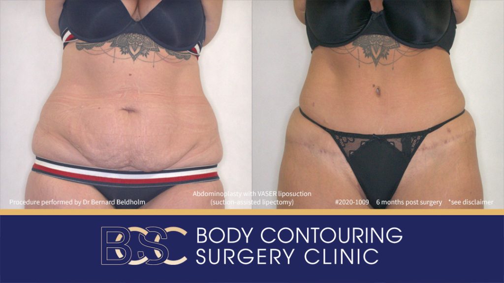 Abdominoplasty with VASER Liposuction (Suction-assisted Lipectomy) (Patient 2020-1009) - Front