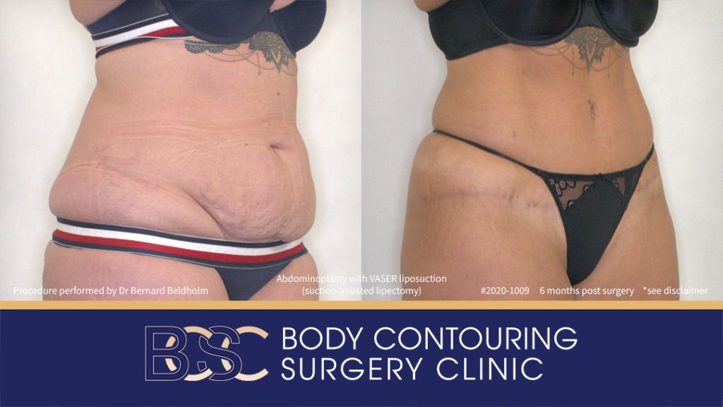 Abdominoplasty with VASER Liposuction (Suction-assisted Lipectomy) (Patient 2020-1009) - Left