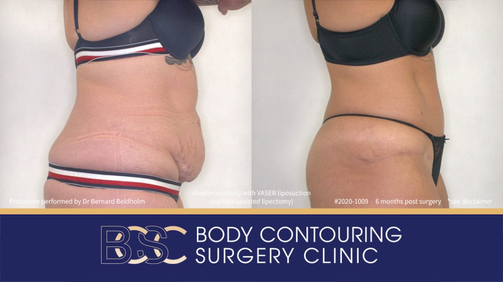 Abdominoplasty with VASER Liposuction (Suction-assisted Lipectomy) (Patient 2020-1009) - Left Side