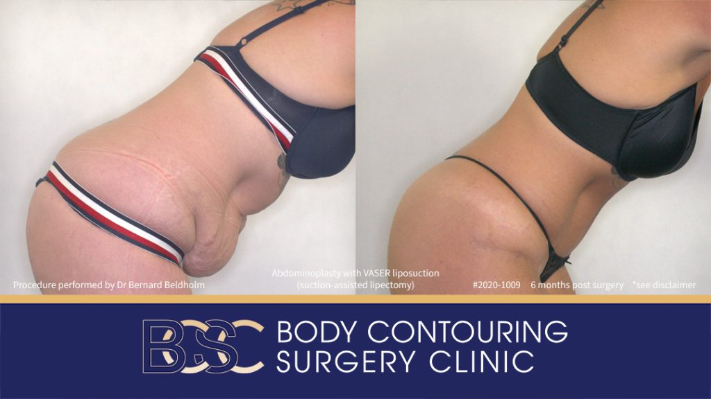 Abdominoplasty with VASER Liposuction (Suction-assisted Lipectomy) (Patient 2020-1009) - Left Side Bend