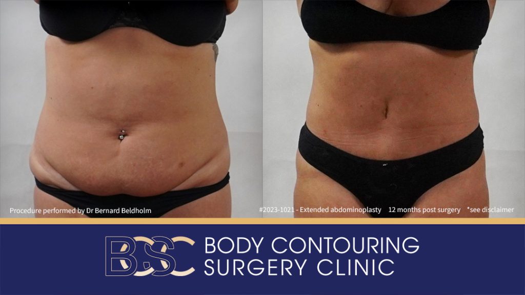 Abdominoplasty Post Weight Loss with VASER Liposuction (Suction-assisted Lipectomy) and Diastasis Recti Repair (Patient 2023-1021) - Front