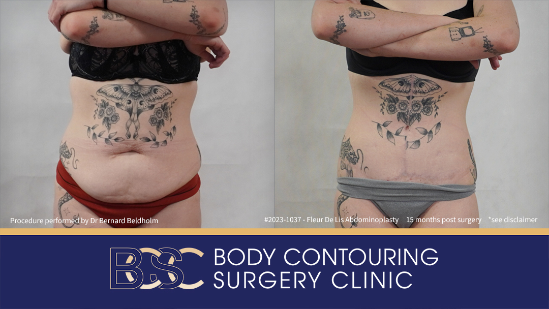 Fleur de Lis Abdominoplasty After Loosing 50kg of Weight (Patient 2023-1037)