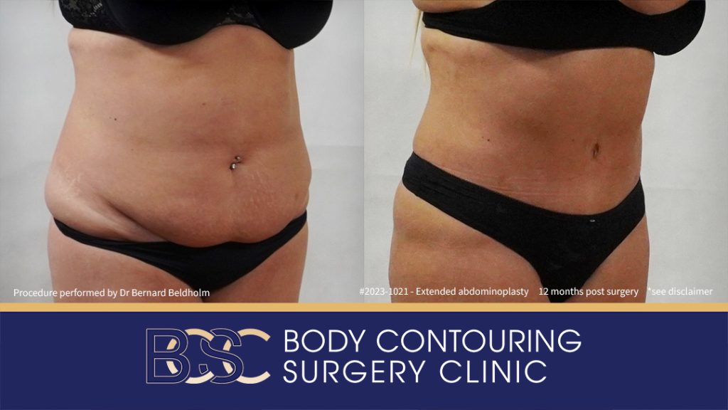 Abdominoplasty Post Weight Loss with VASER Liposuction (Suction-assisted Lipectomy) and Diastasis Recti Repair (Patient 2023-1021) - Left