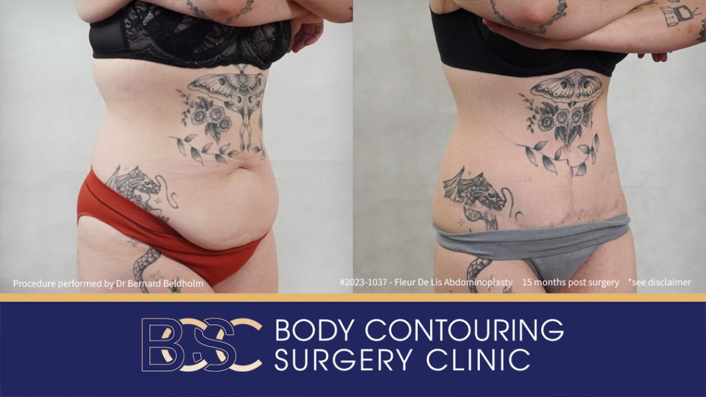 Fleur de Lis Abdominoplasty After Loosing 50kg of Weight (Patient 2023-1037) - Left