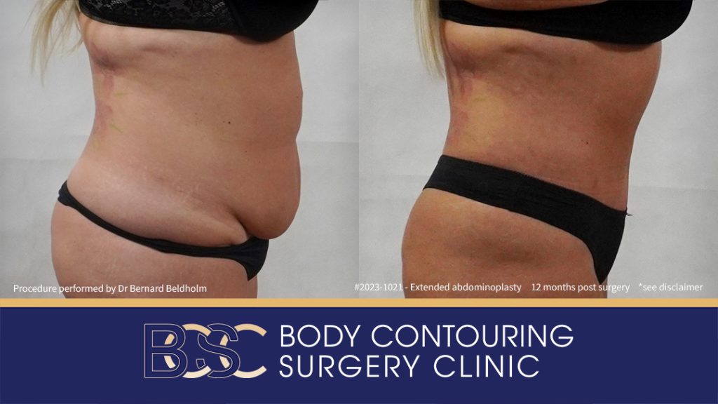 Abdominoplasty Post Weight Loss with VASER Liposuction (Suction-assisted Lipectomy) and Diastasis Recti Repair (Patient 2023-1021) - Left Side