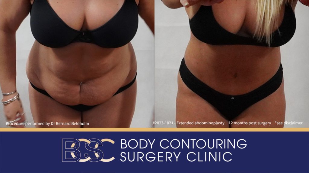 Abdominoplasty Post Weight Loss with VASER Liposuction (Suction-assisted Lipectomy) and Diastasis Recti Repair (Patient 2023-1021) - Front Bend