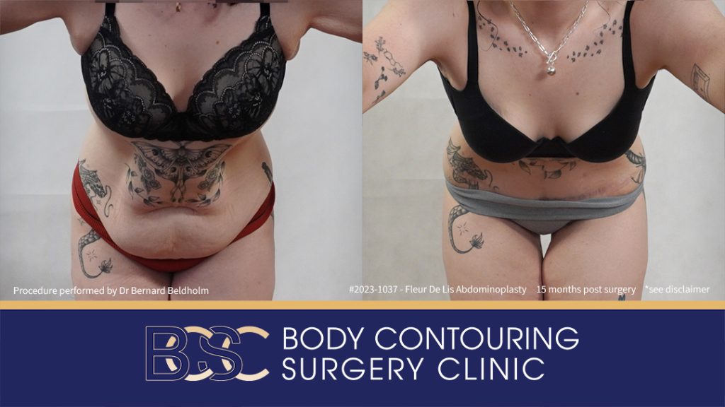 Fleur de Lis Abdominoplasty After Loosing 50kg of Weight (Patient 2023-1037) - Front Bend