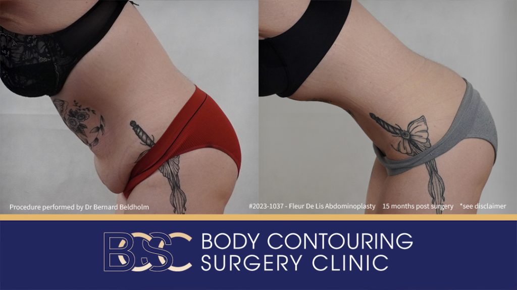 Fleur de Lis Abdominoplasty After Loosing 50kg of Weight (Patient 2023-1037) - Right Side Bend