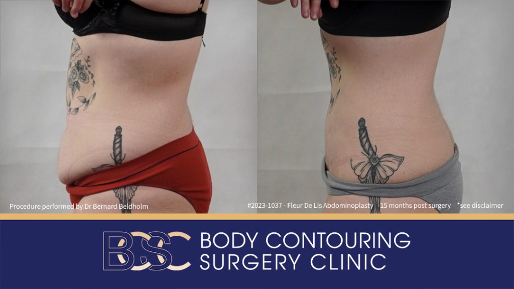 Fleur de Lis Abdominoplasty After Loosing 50kg of Weight (Patient 2023-1037) - Right Side