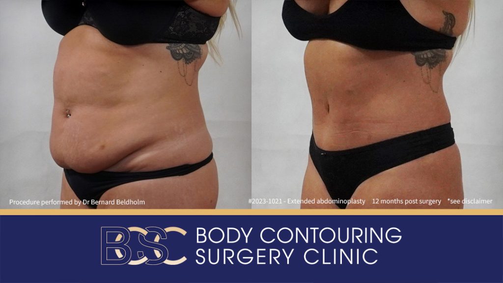 Abdominoplasty Post Weight Loss with VASER Liposuction (Suction-assisted Lipectomy) and Diastasis Recti Repair (Patient 2023-1021) - Right