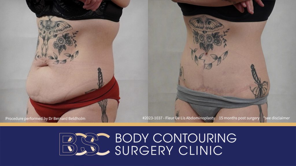 Fleur de Lis Abdominoplasty After Loosing 50kg of Weight (Patient 2023-1037) - Right