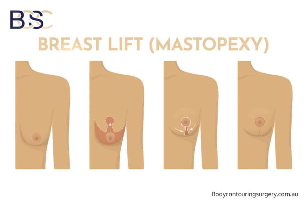 Breast lift (mastopexy) – Repositions and reshapes the breasts