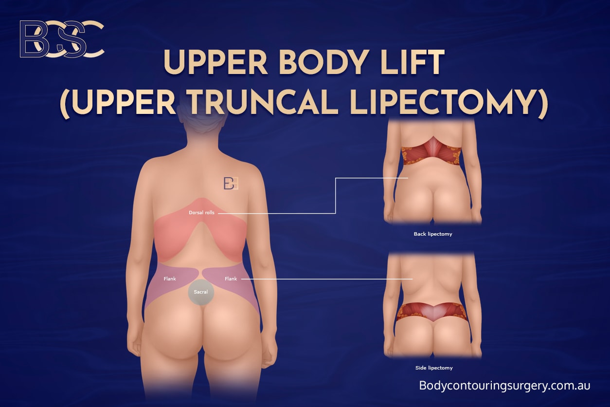 Combining Dual Vector Abdominoplasty With Other Procedures