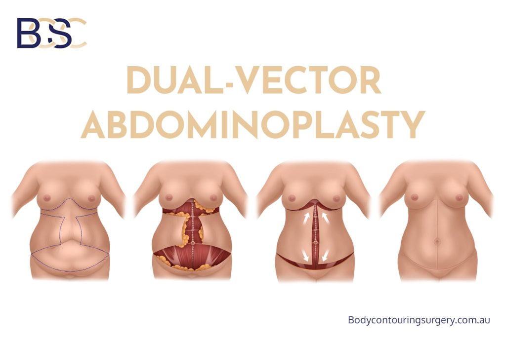 Dual-Vector Abdominoplasty