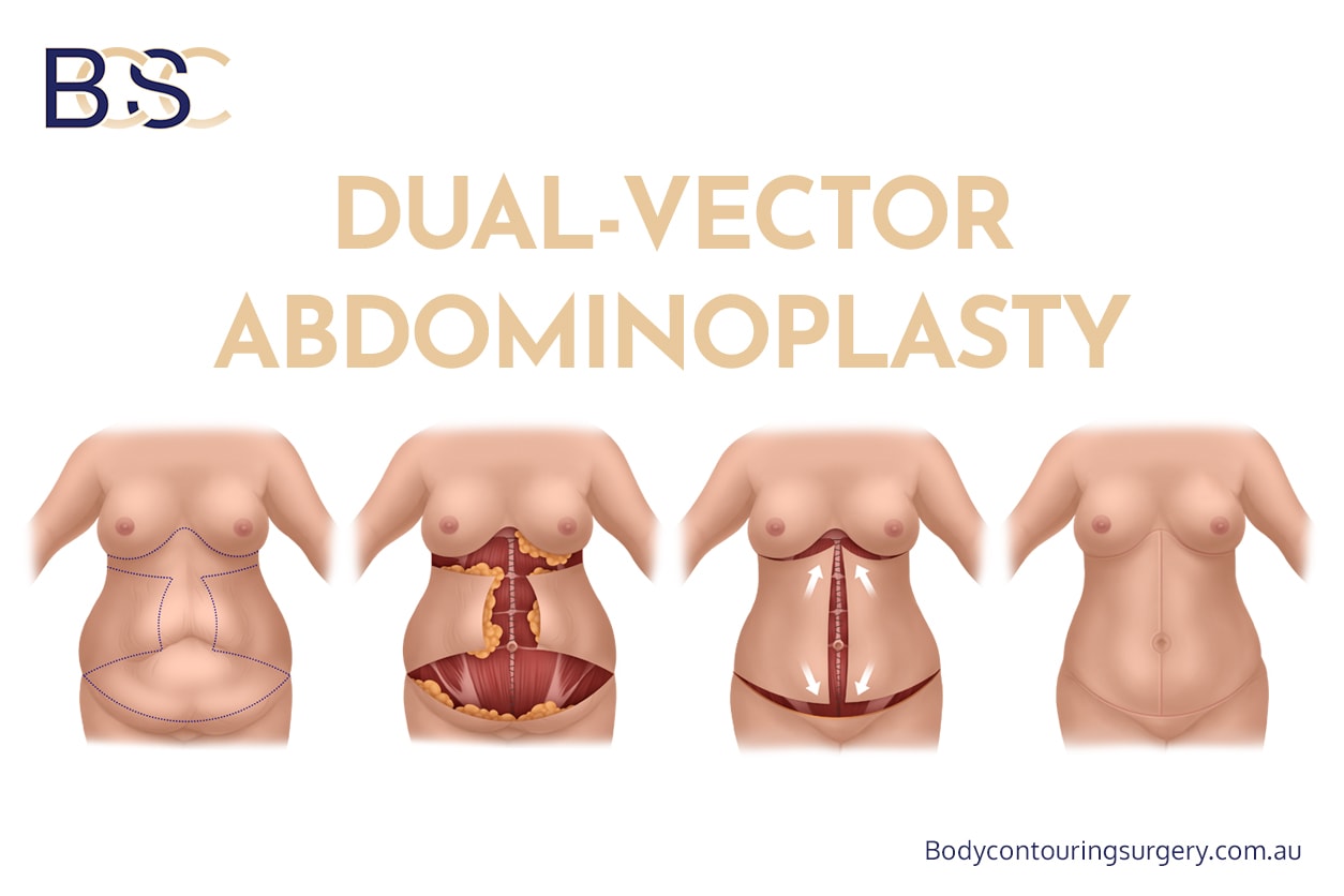 Dual-Vector Abdominoplasty