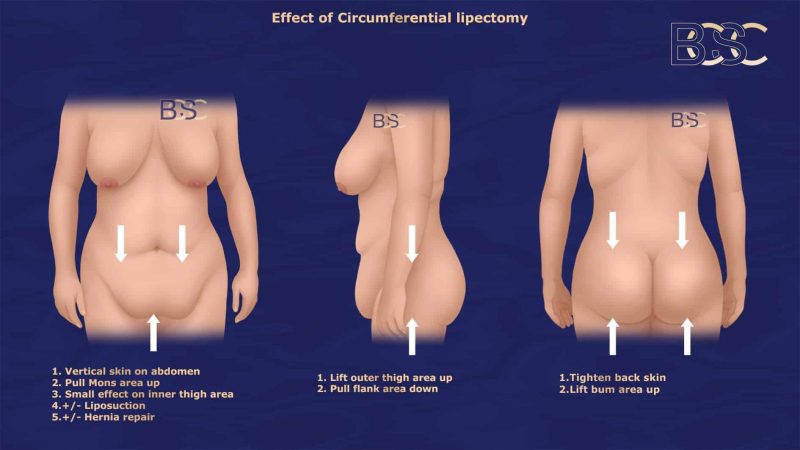 Effects of Circumferential Lipectomy BCSC