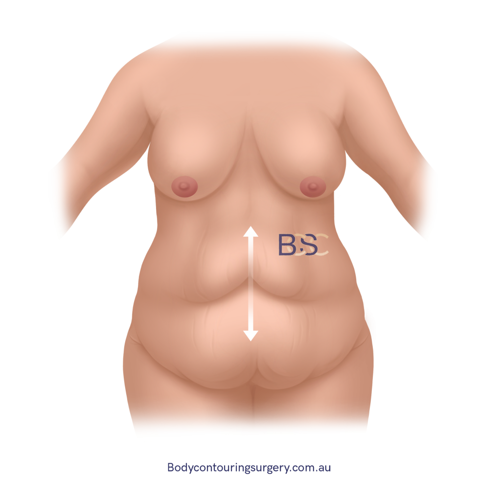 Excess vertical skin - BCSC