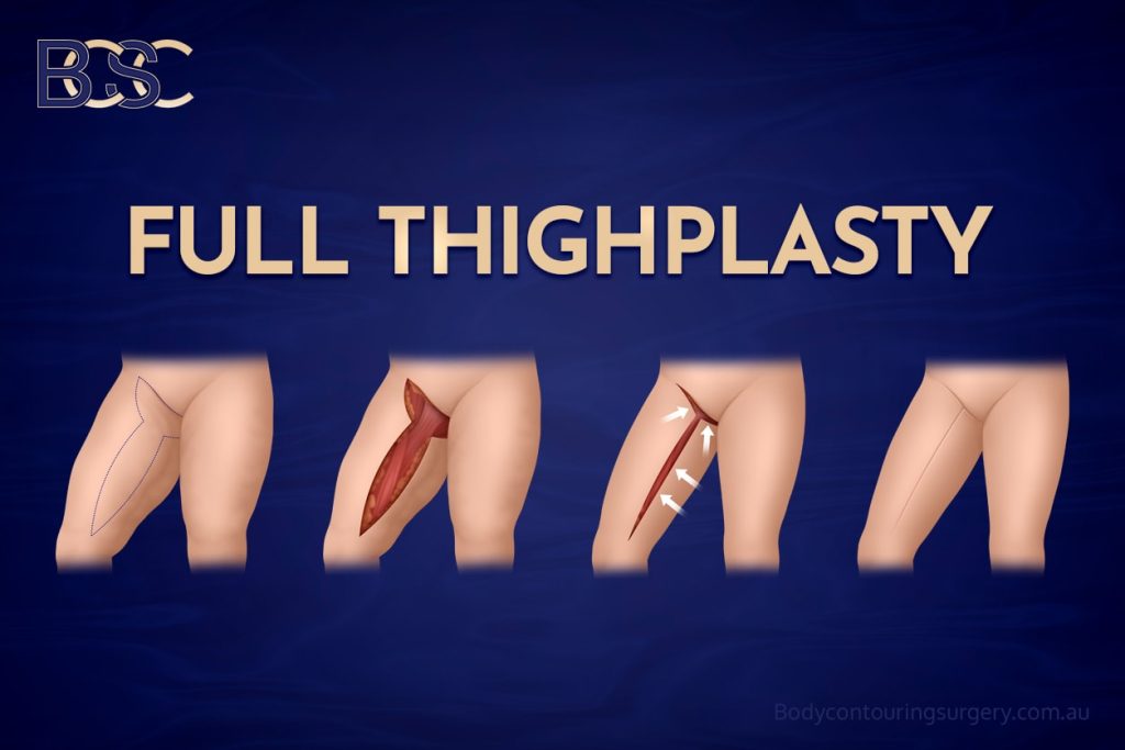 Full Thighplasty