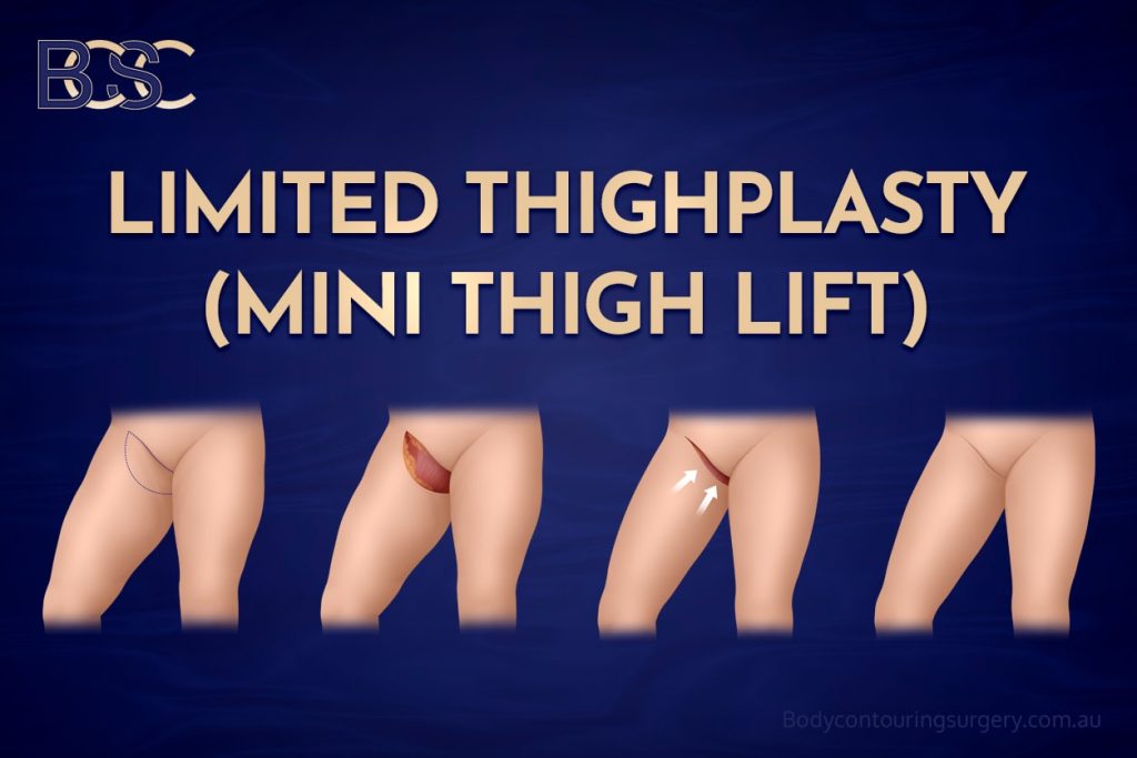 Limited Thighplasty (Mini Thigh Lift)