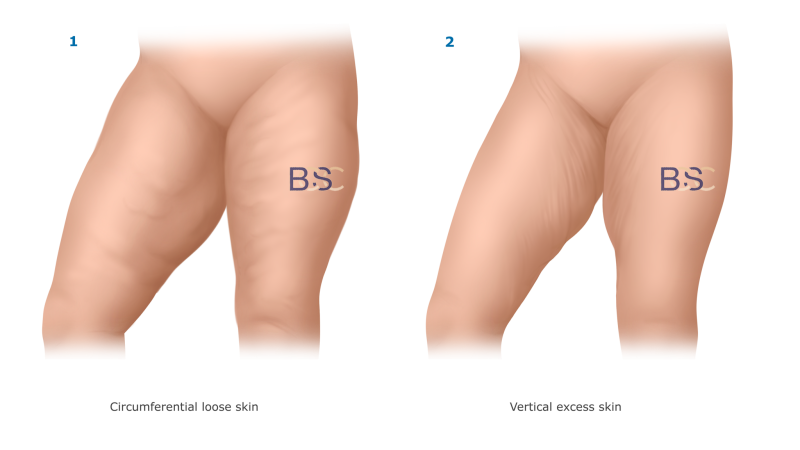Pattern of excess tissue thighs
