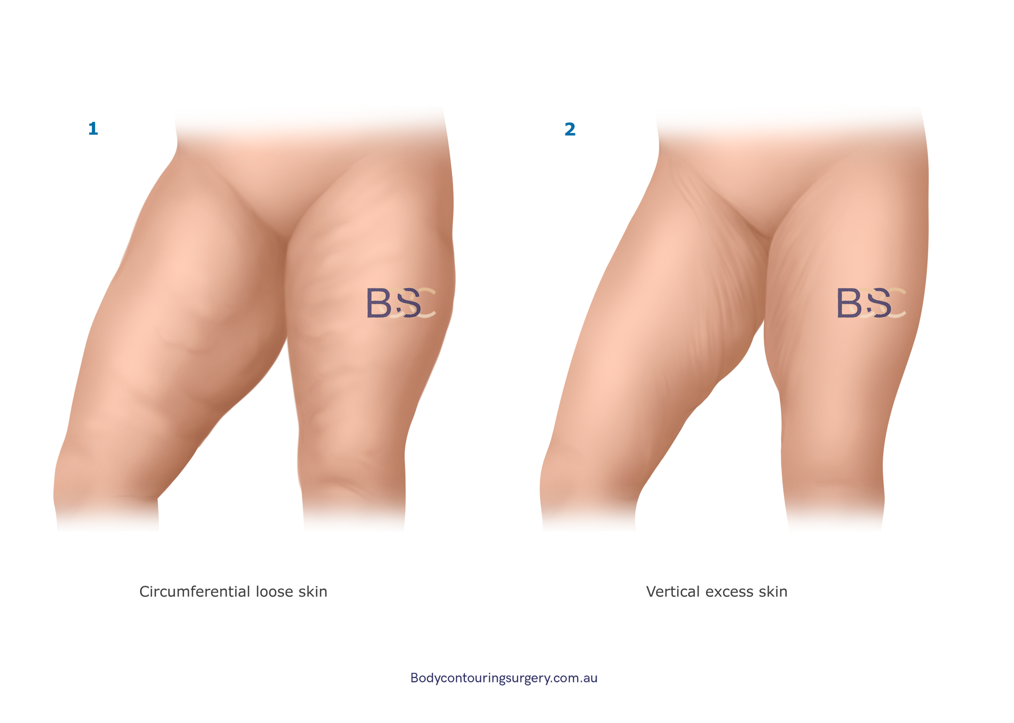 Pattern of excess tissue thighs