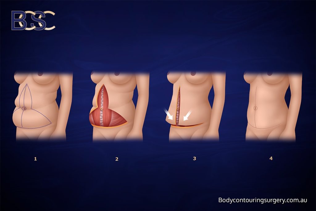The Fleur-de-Lis Abdominoplasty and Its Limitations