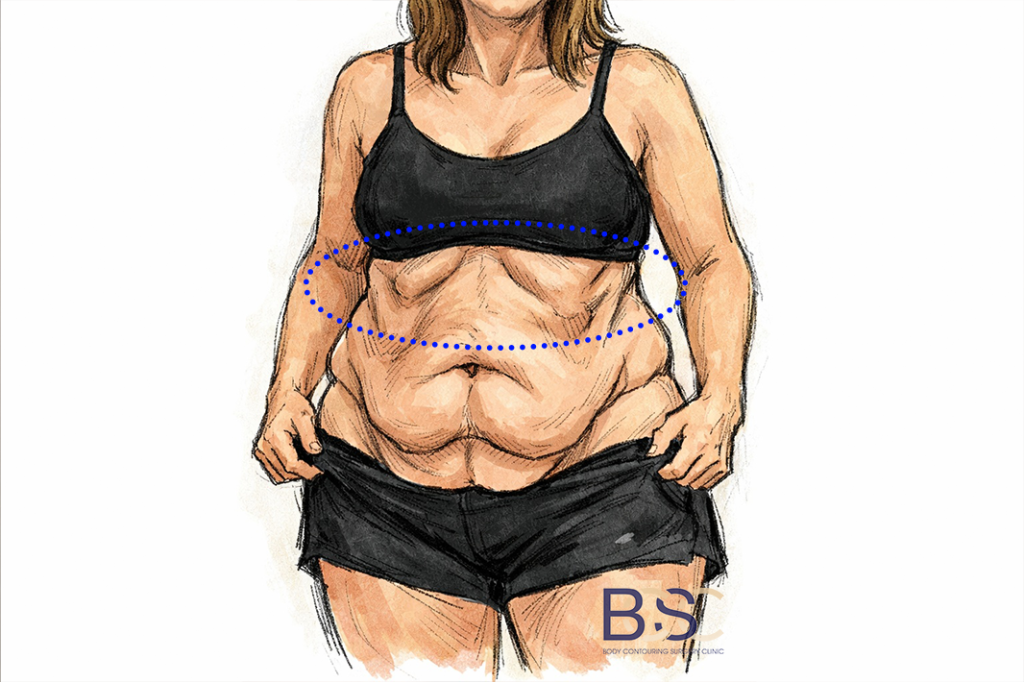 The Upper Abdomen and Lower Chest: An Often Overlooked Area