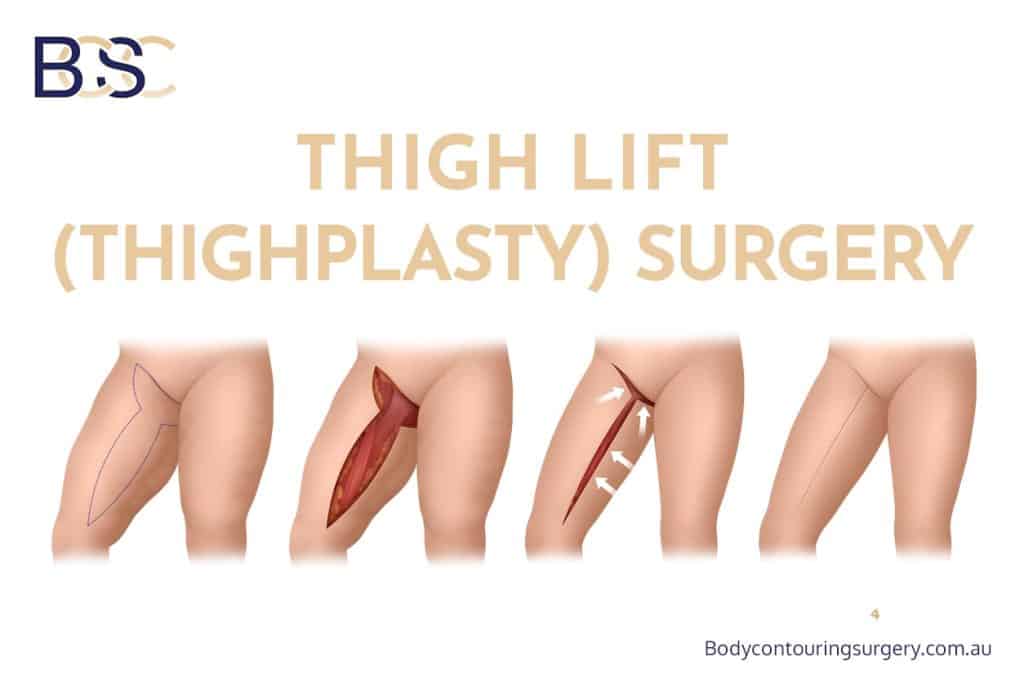 Thigh Lift