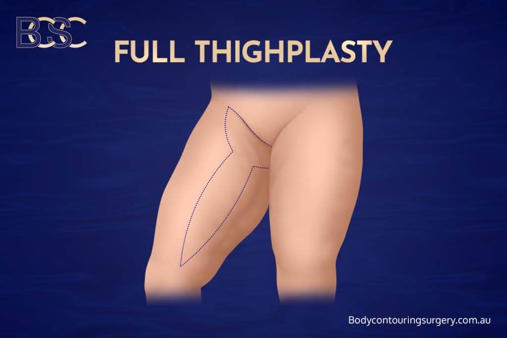 Thigh lift (thighplasty) – Reduces redundant skin and fat from the thighs