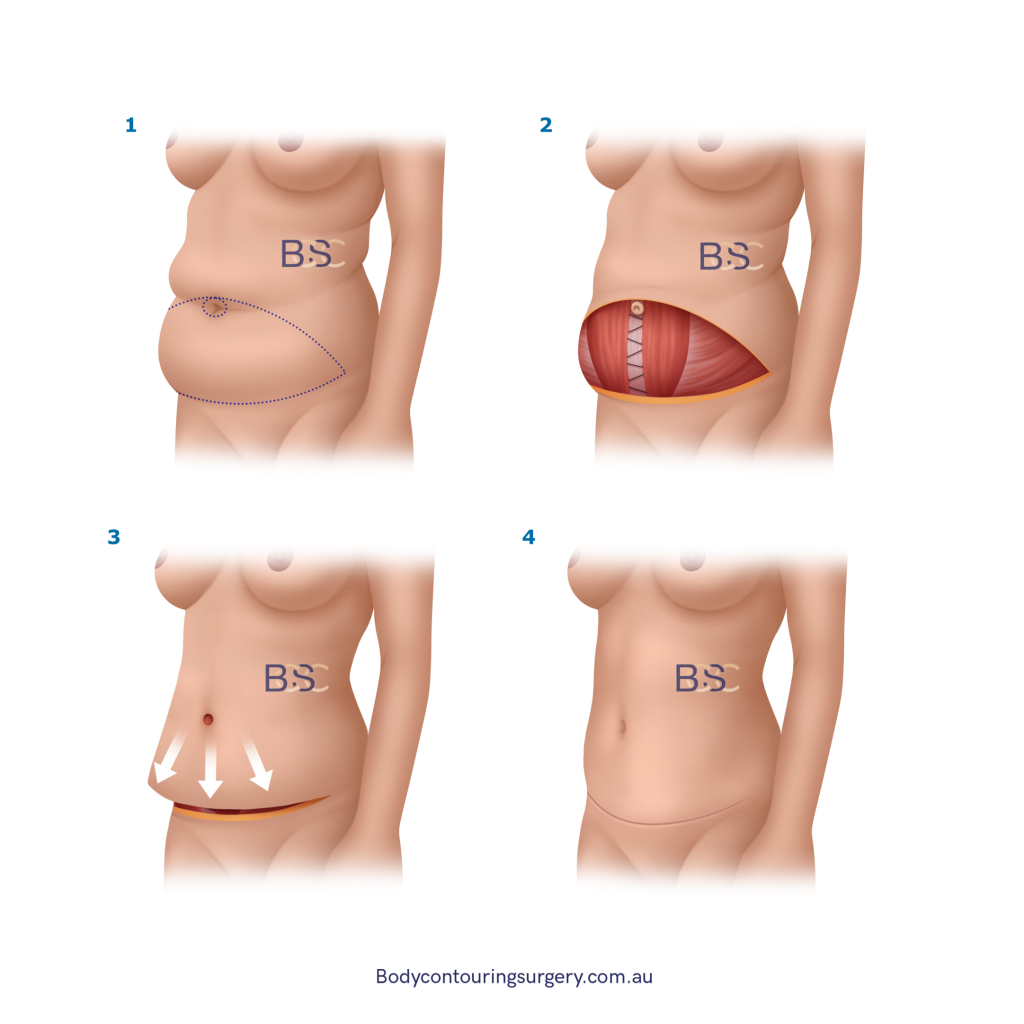 Traditional Abdominoplasty: What It Can and Cannot treat