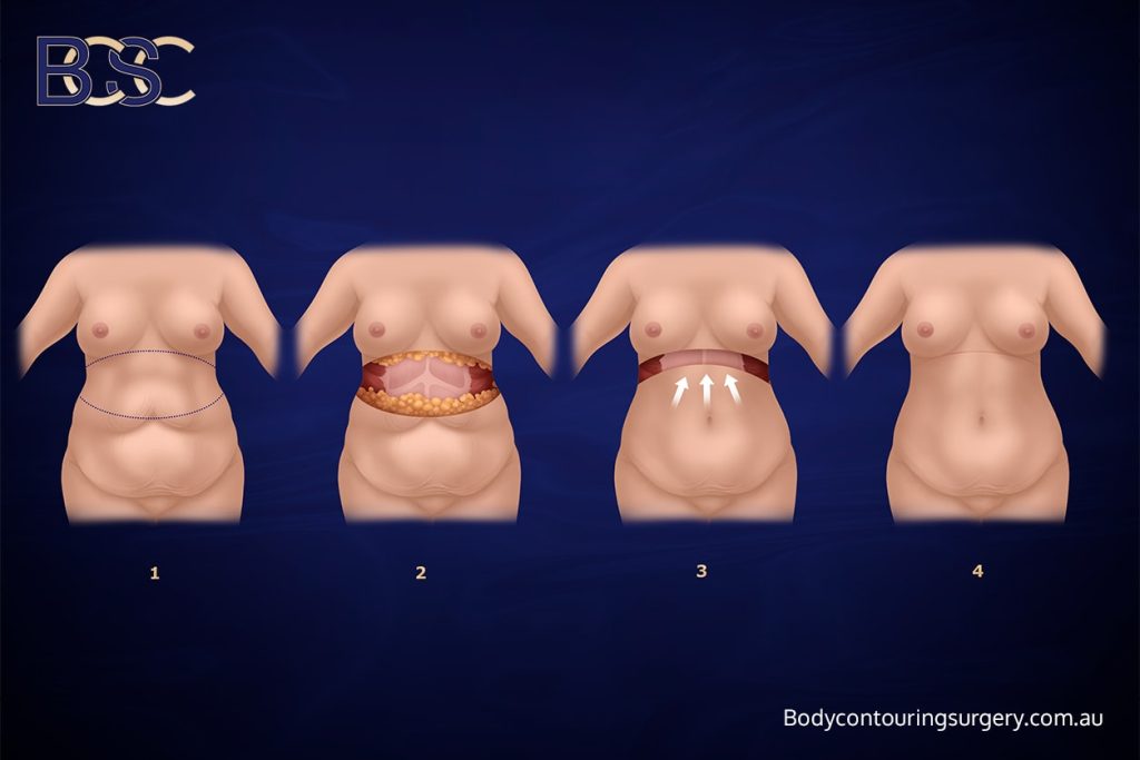 Upper Abdominal Lipectomy: Addressing the Upper Vector