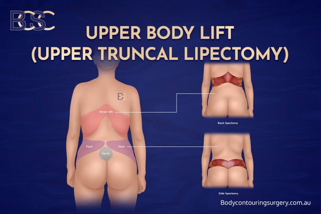 Upper body lift (upper truncal lipectomy) – Treats loose skin and folds on the upper back and flanks