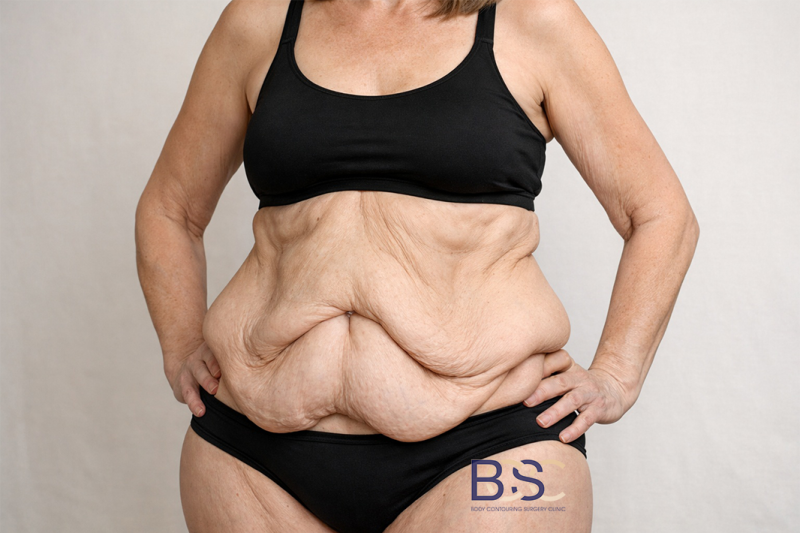 Who May Be Suitable for Dual Vector Abdominoplasty