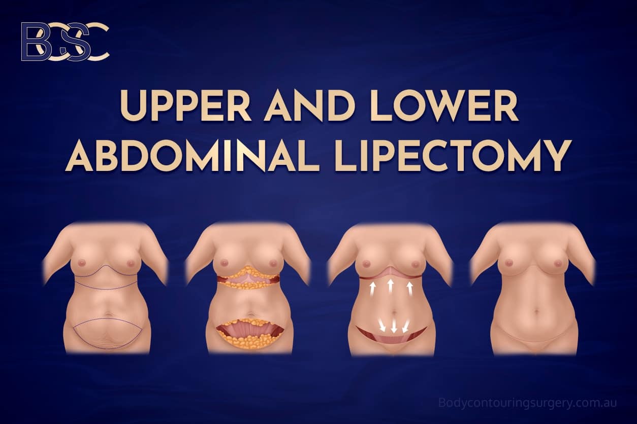Upper & Lower abdominal lipectomy | Body Contouring Surgery Clinic