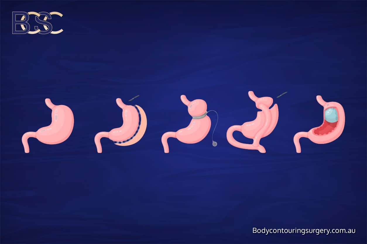 Bariatric surgery | Body Contouring Surgery Clinic