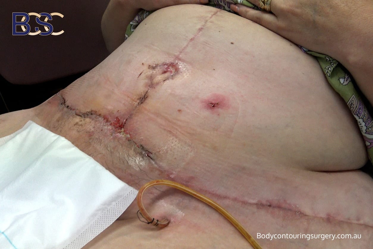 Complications After Dual Vector Abdominoplasty