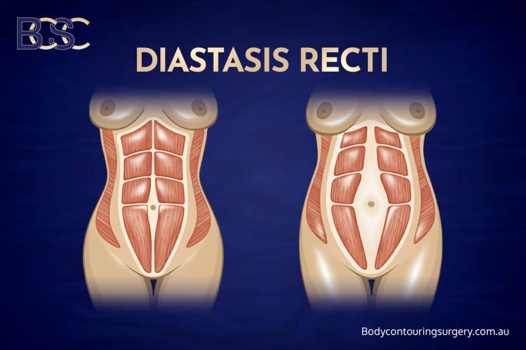 Diastasis recti | Body contouring surgery clinic