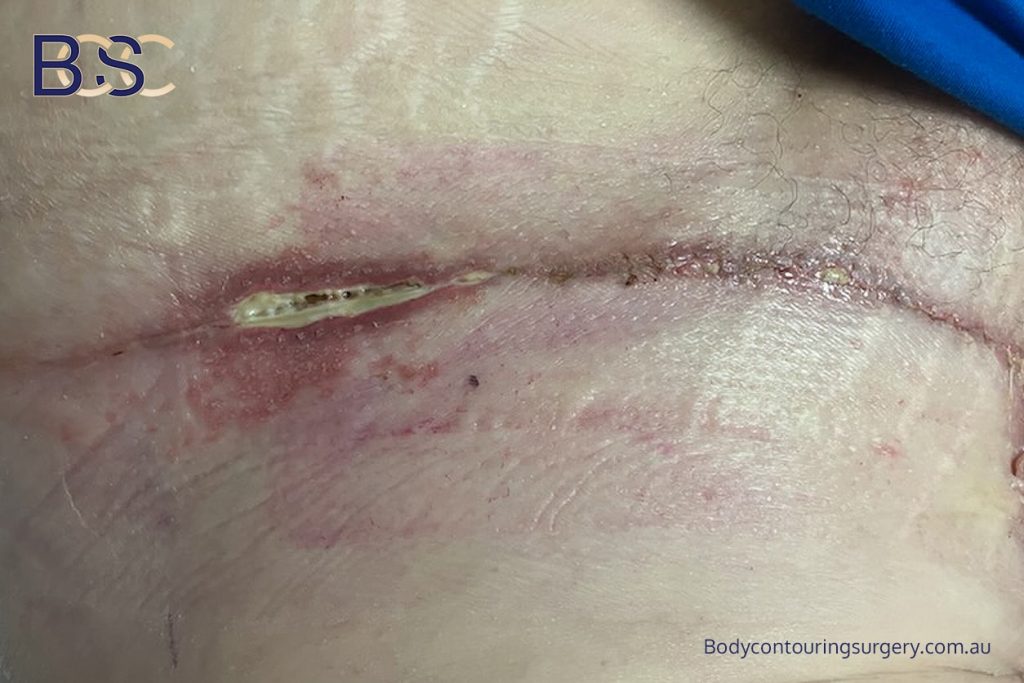 Wound Breakdown