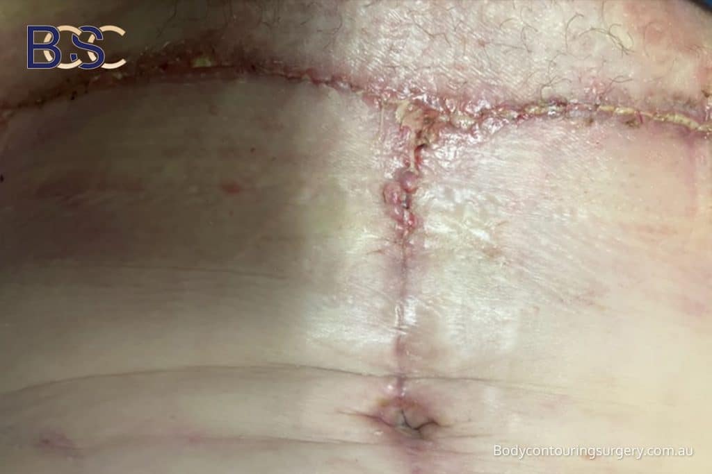 scars with minor breakdown