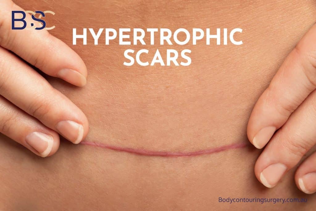 hypertrophic scars