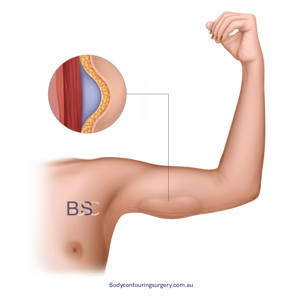 Seroma