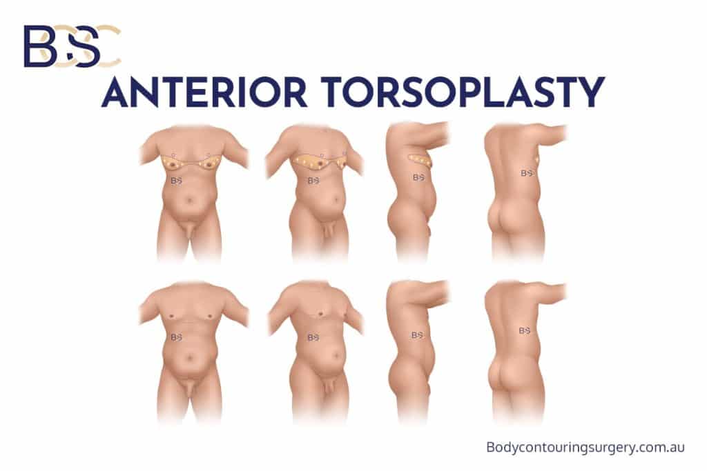 Anterior Torsoplasty
