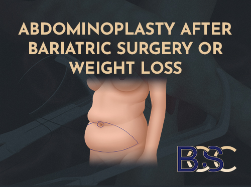 Abdominoplasty After Bariatric Surgery or Weight Loss: Comprehensive Information