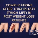 Complications After Thighplasty in Post‑Weight‑Loss Patients