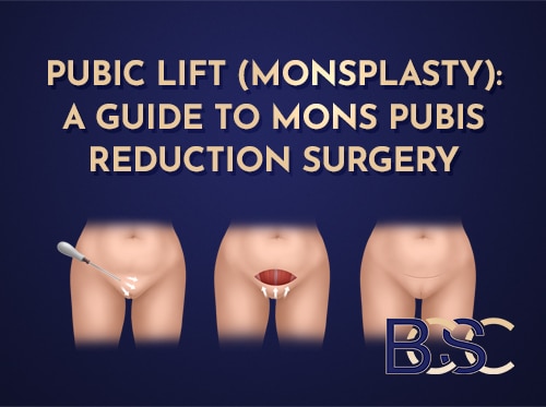 Pubic Lift (Monsplasty): A Guide to Mons Pubis Reduction Surgery