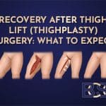 Recovery After Thigh Lift (Thighplasty) Surgery: What to Expect