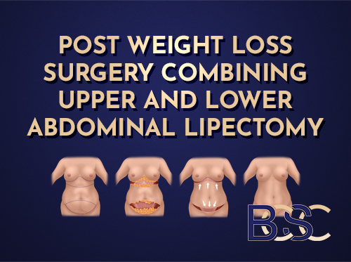 Upper and Lower Abdominal Lipectomy Post Weight Loss