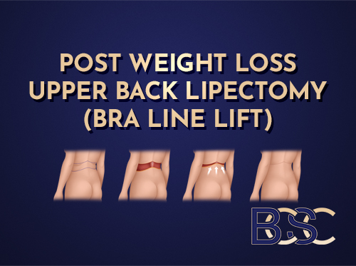Bra Line Lipectomy (Upper Back Lipectomy) After Weight Loss