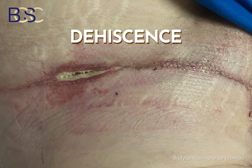 Delayed Wound Healing and Wound Breakdown - Dehiscence